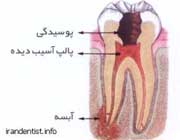 مراحل عصب کشی دندان(با تصاویر) مراحل عصب کشی دندان(با تصاویر)