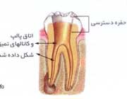 مراحل عصب کشی دندان(با تصاویر) مراحل عصب کشی دندان(با تصاویر)