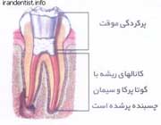 مراحل عصب کشی دندان(با تصاویر) مراحل عصب کشی دندان(با تصاویر)