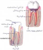 مراحل عصب کشی دندان(با تصاویر) مراحل عصب کشی دندان(با تصاویر)