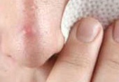 جوش‌های سرسیاه از کجا می‌آیند؟