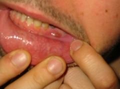آشنایی با آبسه دندان و درمان آن