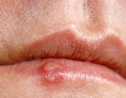 چرا تبخال می زنیم؟