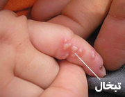 چرا تبخال می زنیم؟