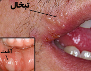 چرا تبخال می زنیم؟