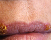 چرا تبخال می زنیم؟