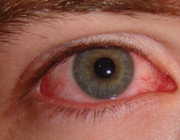 تبخالی در چشم تبخالی در چشم