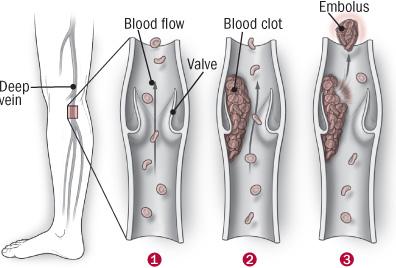 On the alert for deep-vein blood clots