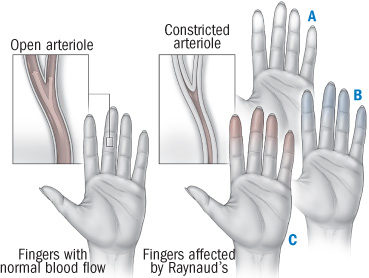 Conditions: Cold fingers, cold toes? Could be Raynaud's