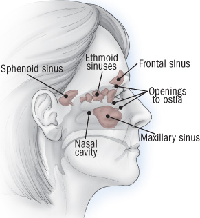 What to do about sinusitis