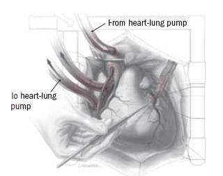 Should bypass surgery be done off-pump?