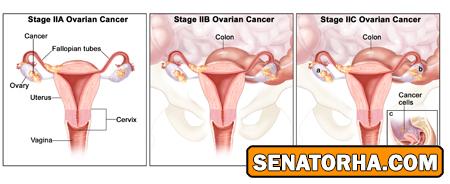 شناخت علائم ، مراحل ، انواع ، پیشگیری و درمان سرطان تخمدان