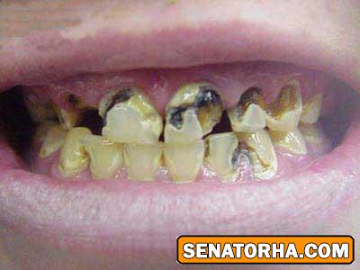 عکسهای تاسف بار از معتادین کراکی (18+)