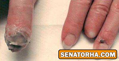 عکسهای تاسف بار از معتادین کراکی (18+)