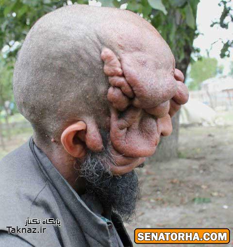 مردی که بخاطر بیماری عجیبش صورت ندارد ! (+ تصاویر)