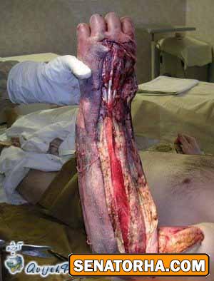 عکسهای تاسف بار از معتادین کراکی (18+)