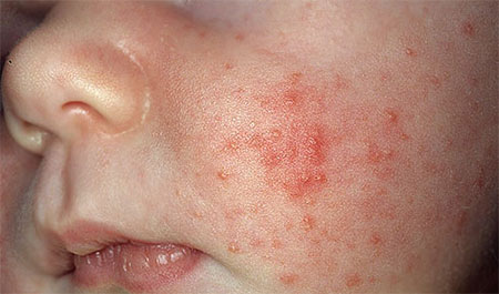 تمام آنچه باید از ویروس سرخک دانست